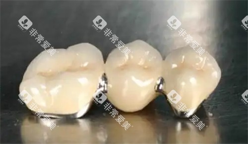牙冠照片