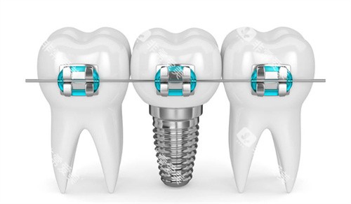 种植牙牙齿矫正图片