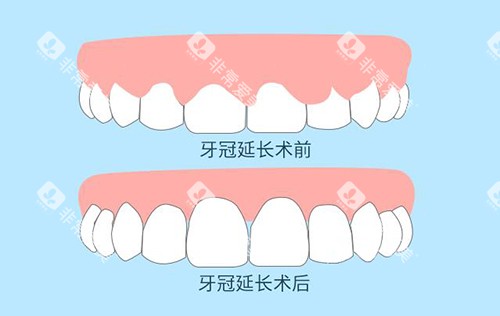 牙冠延长前后对比照片