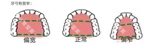 牙齿矫正牙弓形状