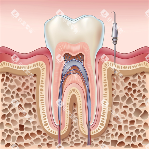 牙齿根管治疗漫画示意图 牙齿根管治疗漫画示意图