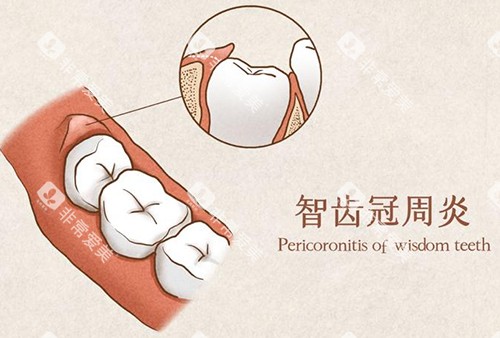 智齿冠周炎漫画示意图 智齿冠周炎漫画示意图