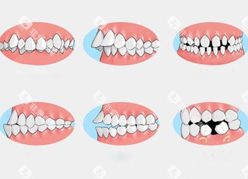 需要牙齿矫正的问题1 需要牙齿矫正的问题1