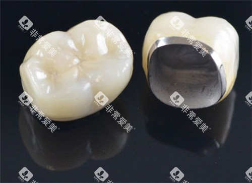 烤瓷牙冠