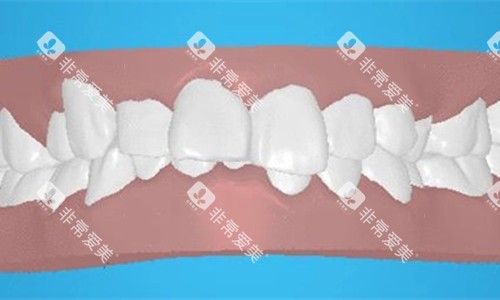 牙齿深覆合卡通图