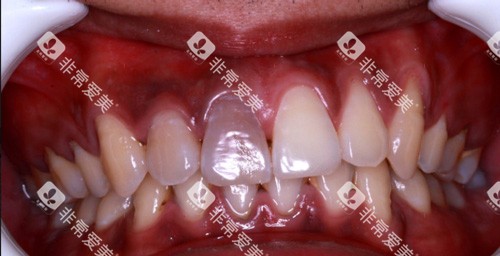 牙齿龋坏表现图