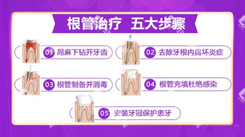 根管治疗的步骤