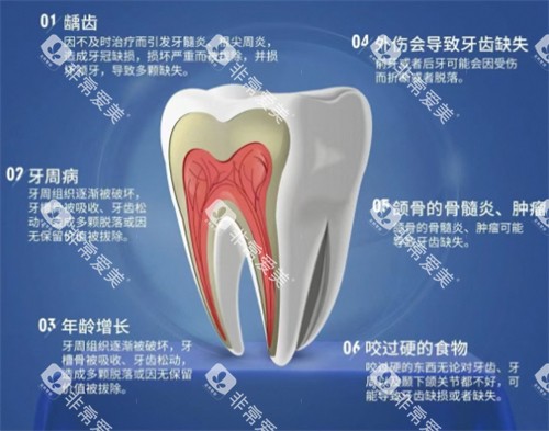 牙齿缺失原因