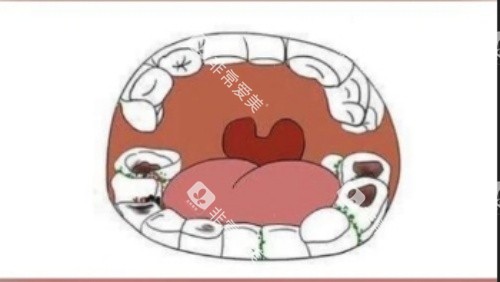牙齿腐蚀漫画示意图