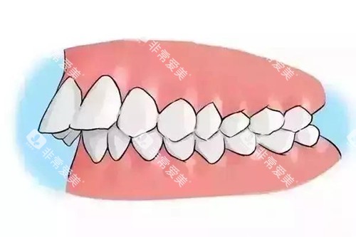 深覆合牙齿突出卡通示意图 深覆合牙齿突出卡通示意图