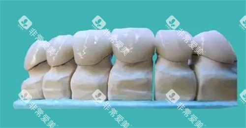 牙齿修复模型图 牙齿修复模型图