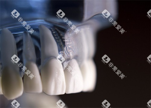 种牙动画图示