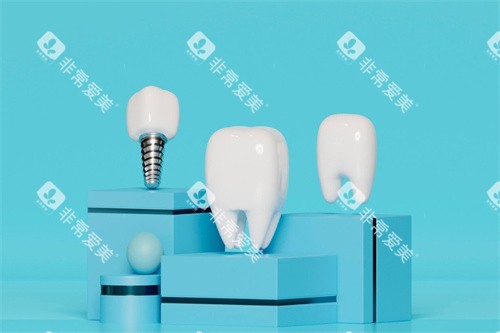 种植牙牙冠展示 种植牙牙冠展示