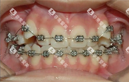 牙齿矫正过程图