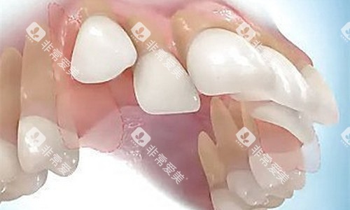 牙齿突兀卡通图