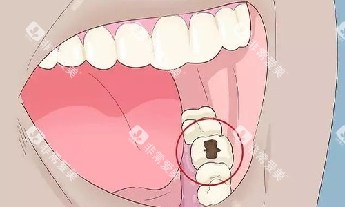 牙齿坏了
