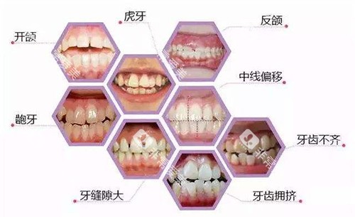 牙齿矫正适应症展示图