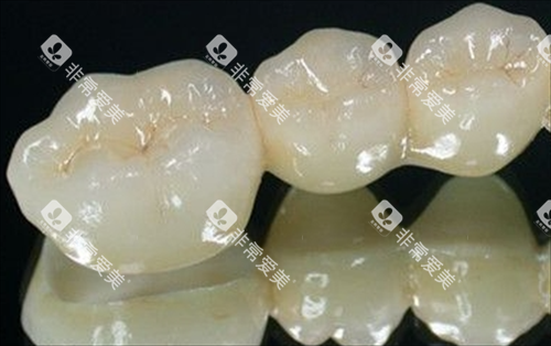 全瓷牙模型展示 全瓷牙模型展示