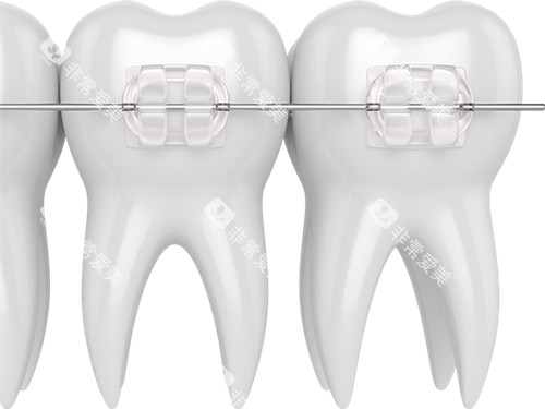 牙齿矫正陶瓷托槽漫画图 牙齿矫正陶瓷托槽漫画图
