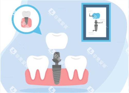 种植牙种植过程 种植牙种植过程