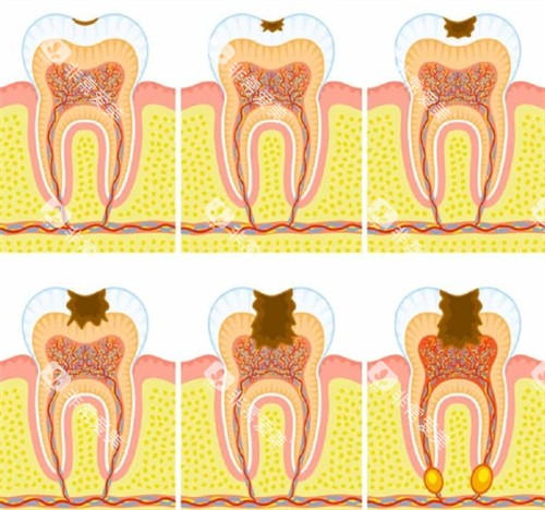 需要根管治疗的牙齿 需要根管治疗的牙齿