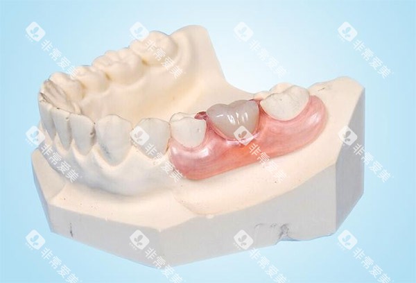 镶牙示意图 镶牙示意图