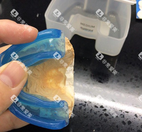 牙齿矫正MRC早期肌功能矫正器石膏模型试戴