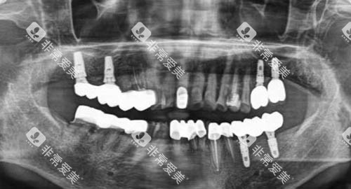 多颗牙齿种植ct