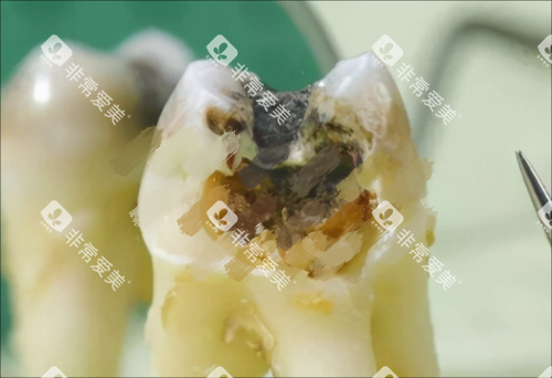 烂牙齿图片展示