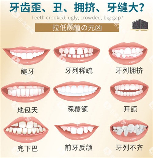 牙齿矫正适应症图示