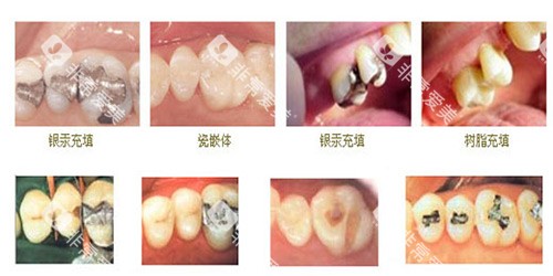 不同牙齿修补示意图