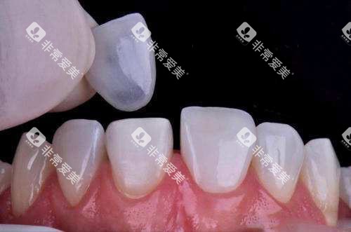 牙齿贴面过程