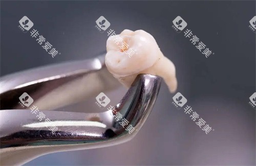 拔掉的牙齿照片