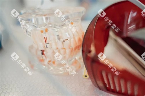 牙齿正畸示意图