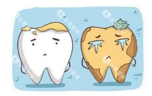 需要清洁的牙齿卡通示意图