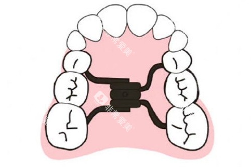 正畸扩弓卡通图