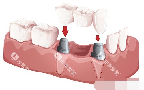 两颗种植牙安装联排牙冠漫画图