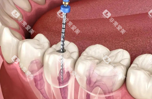 根管治疗动画透视图 根管治疗动画透视图