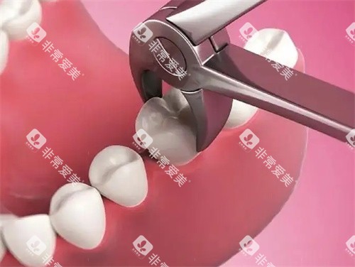 拔牙动画图 拔牙动画图