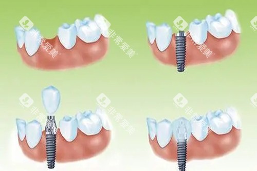 单颗种植牙种植过程卡通示意图