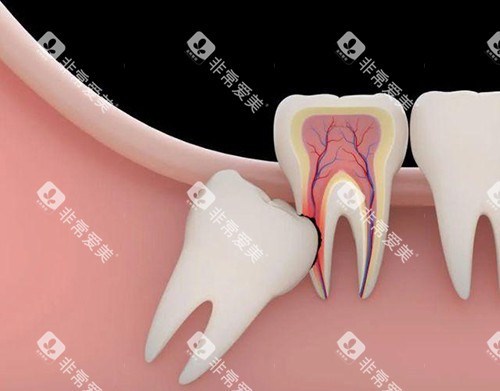 智齿漫画示意图
