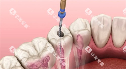 根管治疗动画示意图