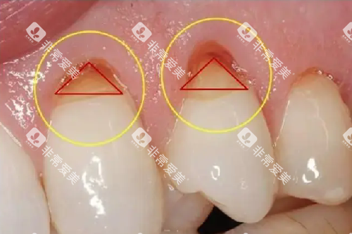 牙齿楔状缺损.webp