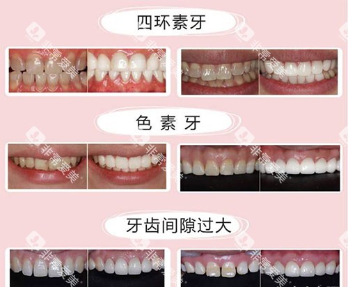 不同牙齿需要美白的示意图
