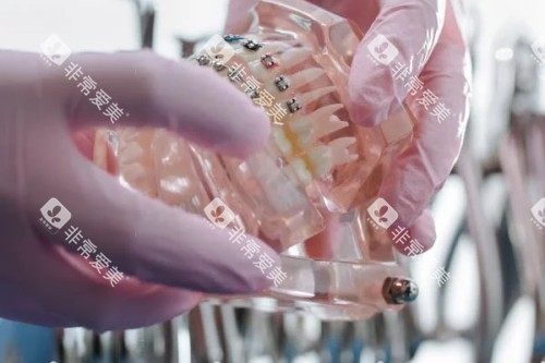 牙齿模型参考图