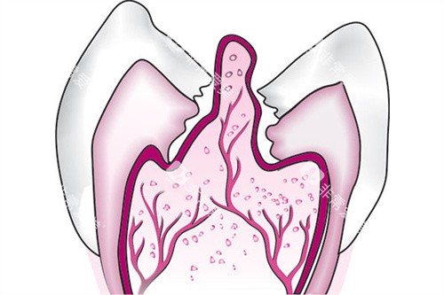 牙齿内息肉侧面图