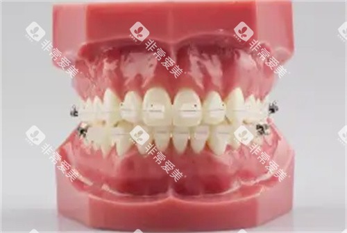 半隐形矫正牙齿模具图