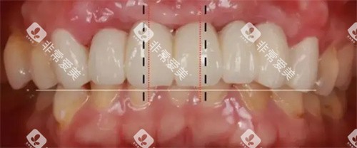 牙齿修复数据测量