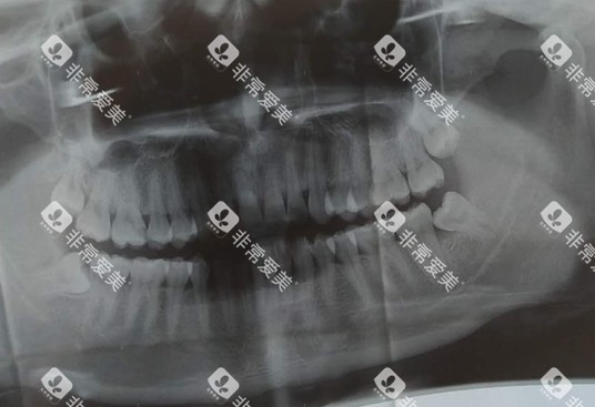 口腔牙齿ct照片