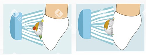 牙齿矫正OBrace球面托槽清洁侧面图